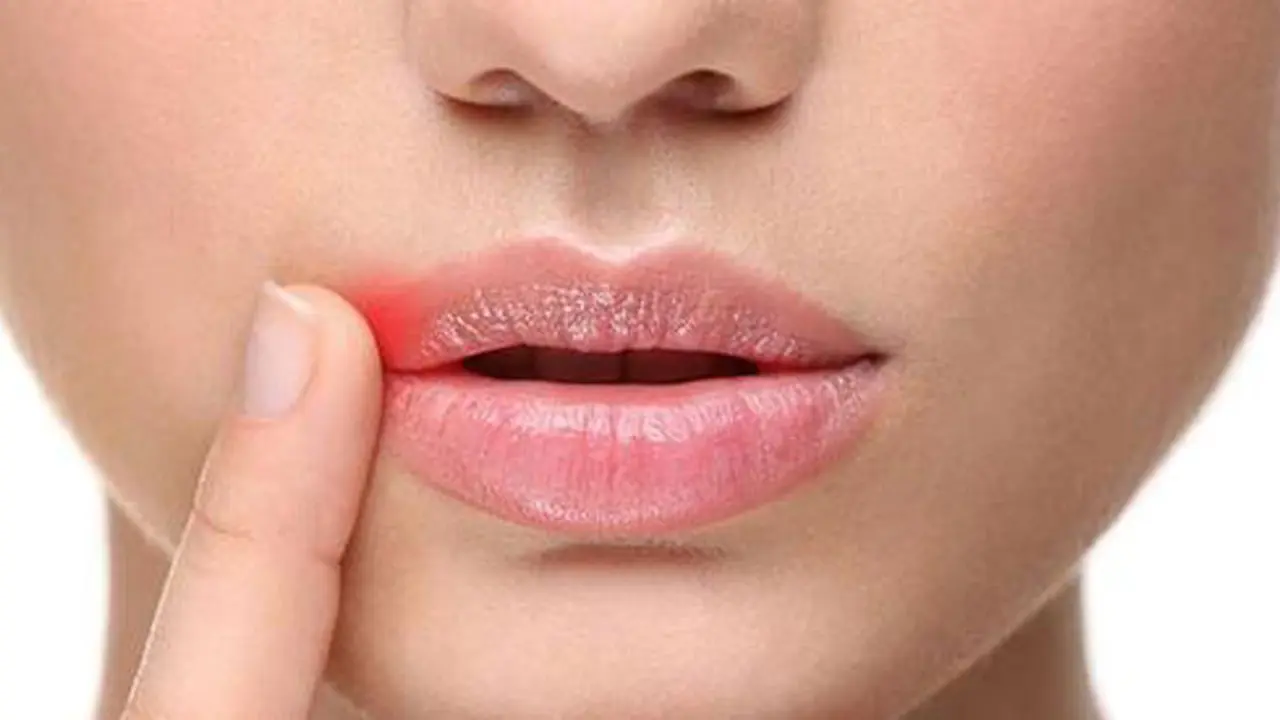 Раздражение в уголках губ – что делать с «заедами»?
