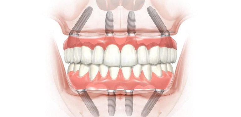 После проведения имплантации зубов организм какое-то время адаптируется к новым условиям