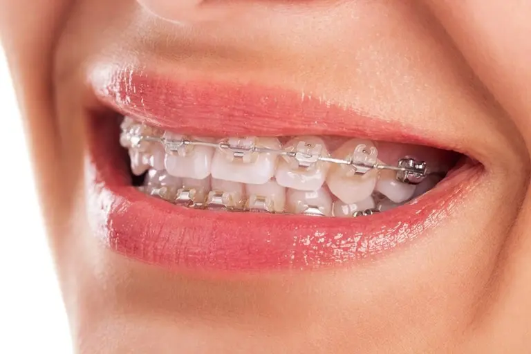 Способы лечения и коррекции смещения зубов
