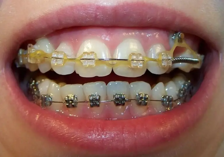 Почему зубы двигаются в брекетах
