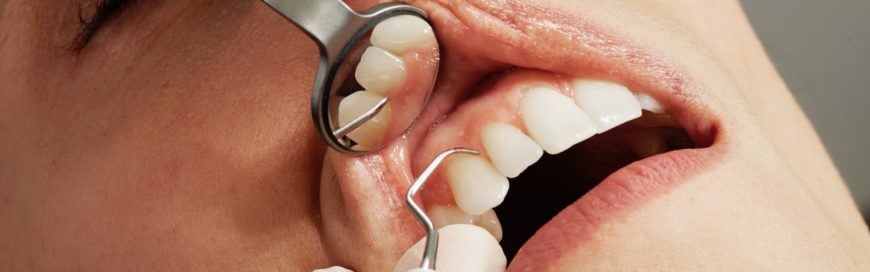 Лечение зубов по ОМС: список бесплатных услуг и подводные камни