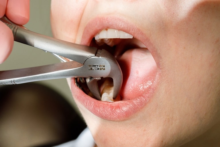 Процедура экстракции зуба