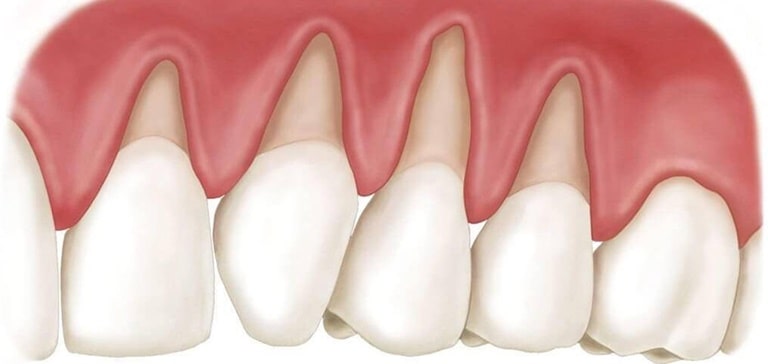 Причины того, почему десна отходит от зуба