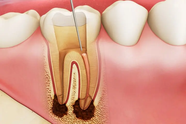 Причины воспаления корня зуба