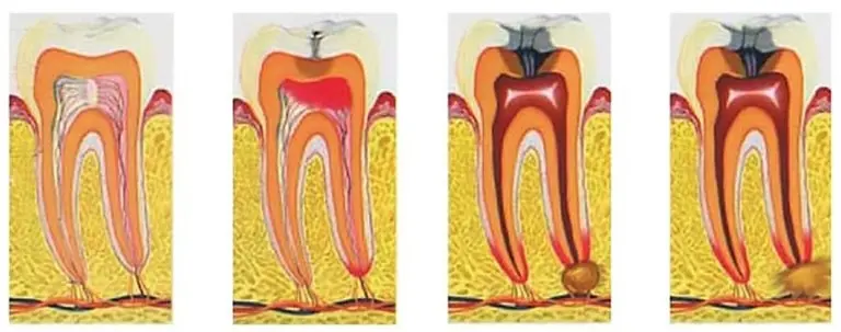 Виды, признаки и симптомы воспаления корня зуба