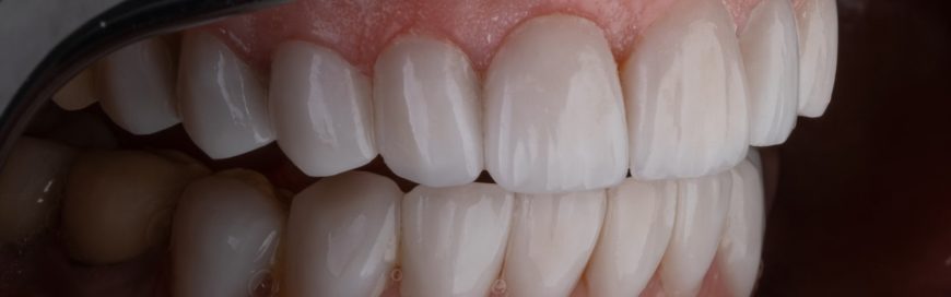 Удаление верхних зубов: показания, проведение, заживление
