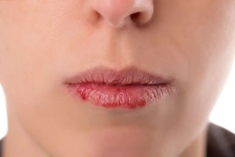 Причины заболеваний губ у человека