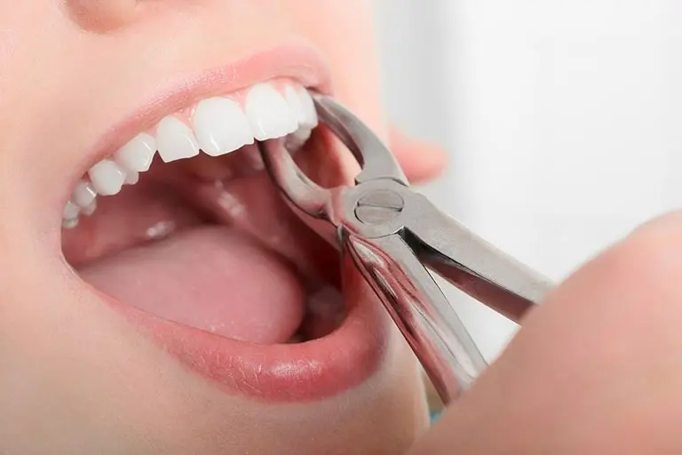 Что собой представляет процедура удаления верхних зубов