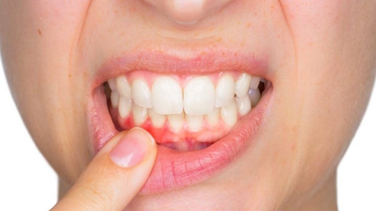 Боли после чистки зубов при пародонтозе
