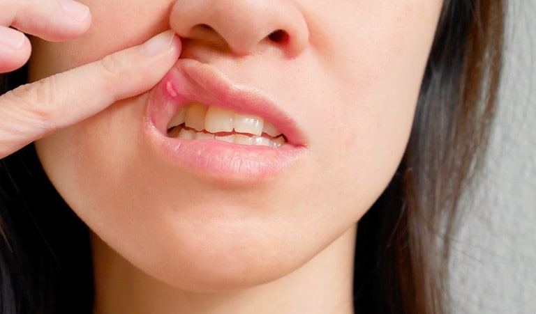 Симптомы появления грибка в полости рта