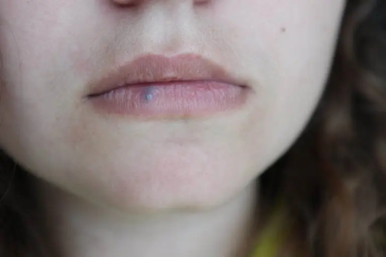 Можно ли вылечить заболевания губ в домашних условиях