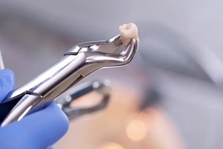 Как проводится удаление верхних зубов
