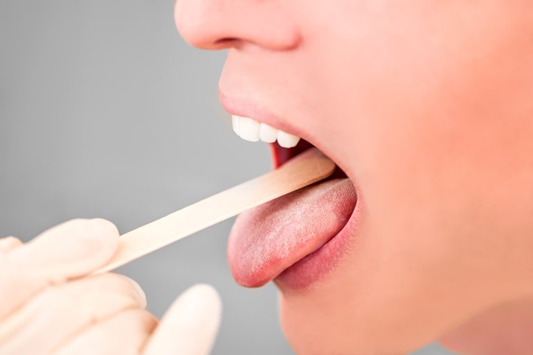 Шишки – эпителиальные опухоли полости рта
