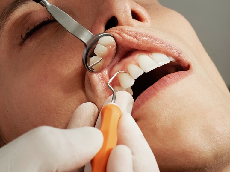 3 вида патологичных разрушений зуба кроме кариеса
