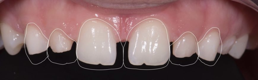 Маленькие зубы: проблема микродентии