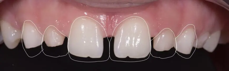 Почему зубы прозрачные? – 7 причин, 1 решение
