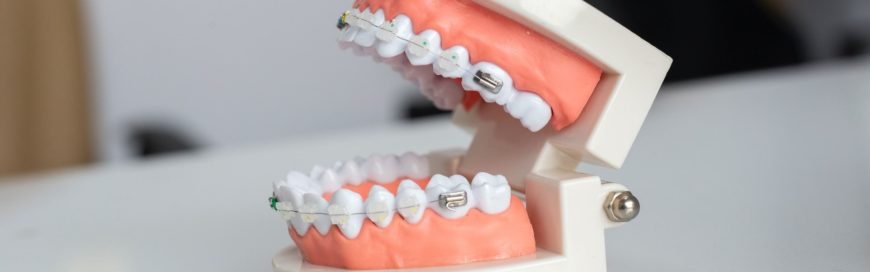 Из-за чего крошатся зубы?