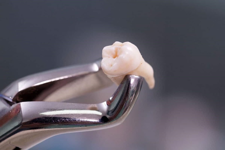 Заживление лунки после удаления зуба