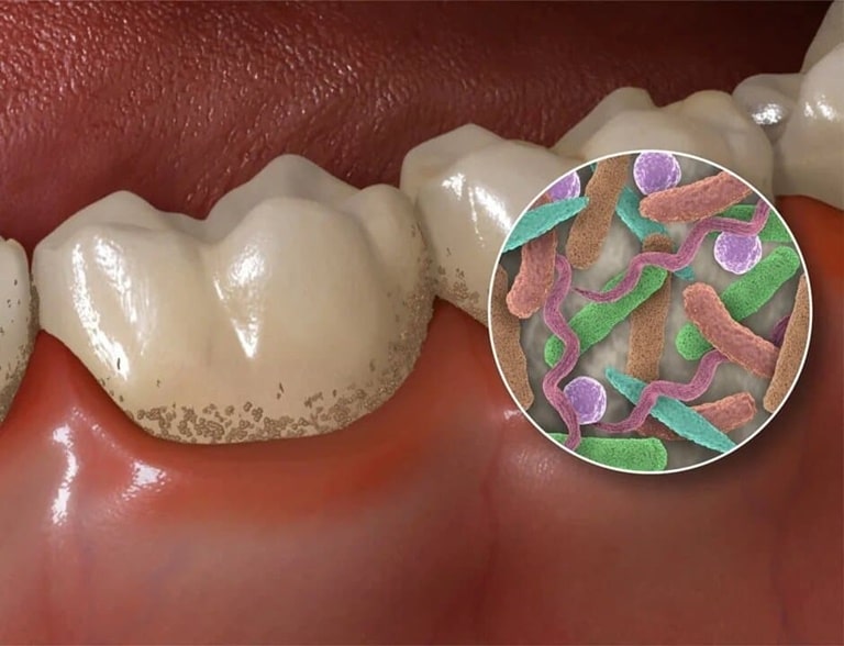 Микрофлора и бактерии в полости рта