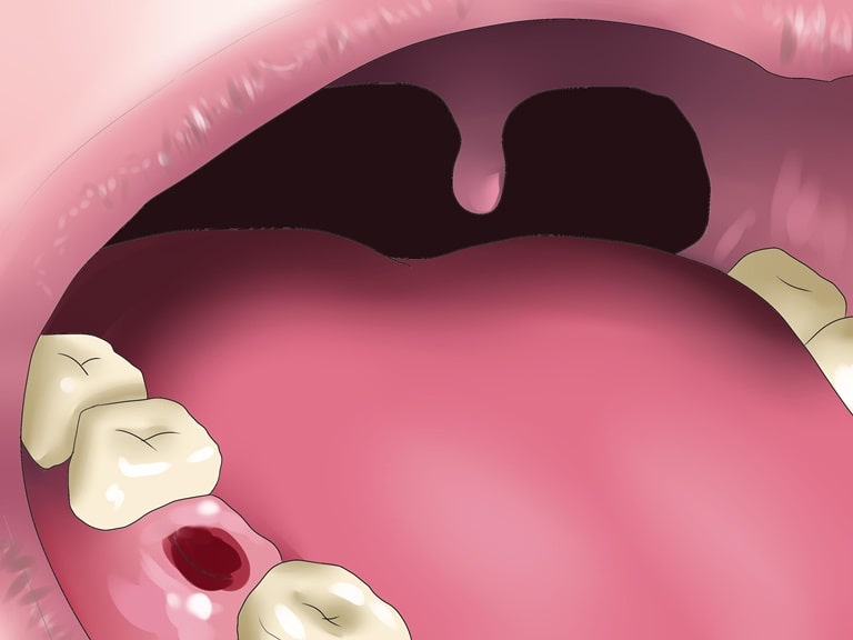 Причины кровотечений после удаления зуба