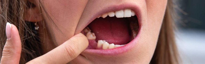 Почему выпадают зубы у взрослого и что с этим делать?