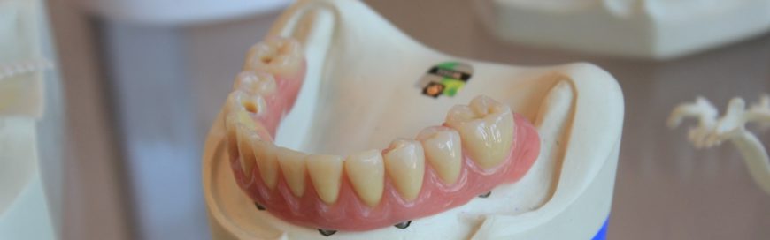 Как держится зубной протез: опоры и фиксирующие средства