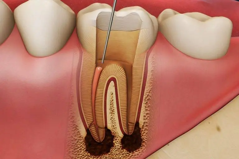 Острая зубная боль тоже является показанием к удалению пульпы