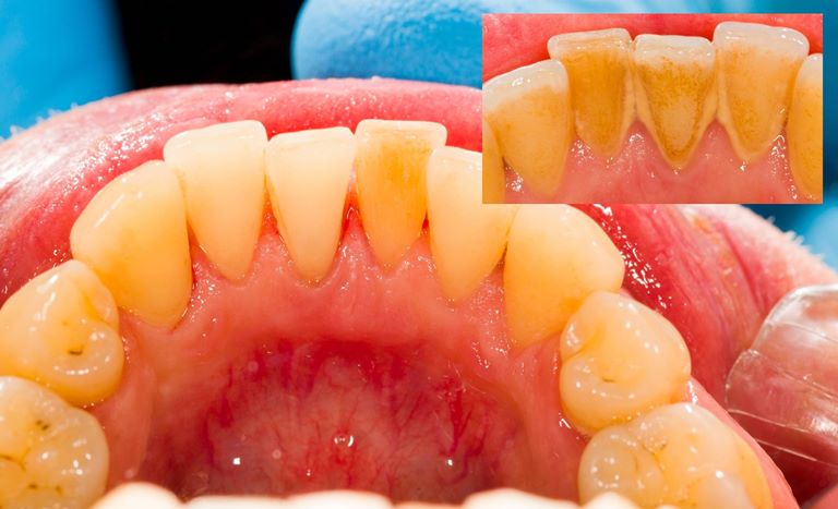 Что такое налет на зубах