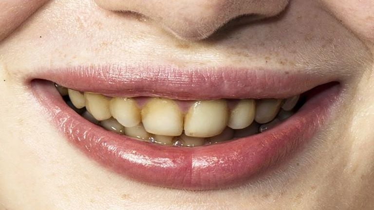 Почему появляется коричневый налет на зубах
