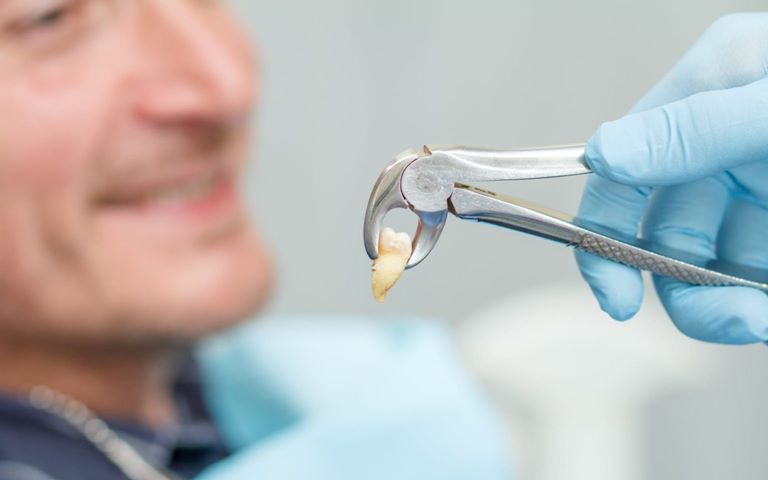 Сохранение альвеолы после удаления зуба
