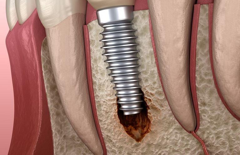 Когда зубной имплант может отторгнуться
