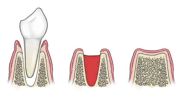 Альвеолит после удаления зуба
