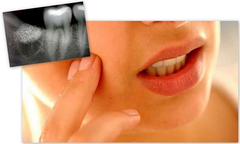 Симптомы и лечение альвеолита после удаления зуба
