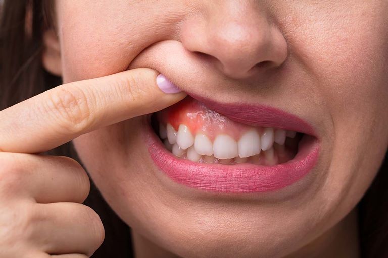 Предвестники выпадения зубов у взрослого
