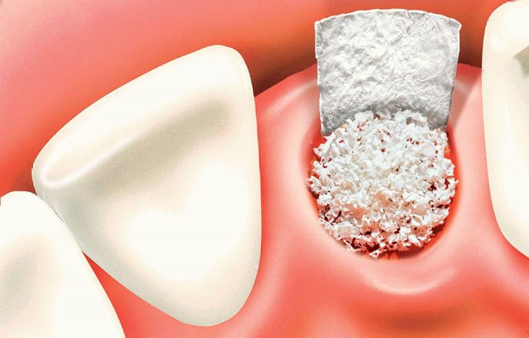 Распад кровеносного сгустка при воспалении альвеолы зуба происходит из-за ускоренного фибринолиза