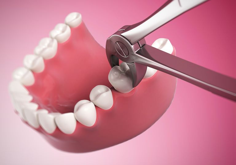 Последствия выпадения зубов у взрослого

