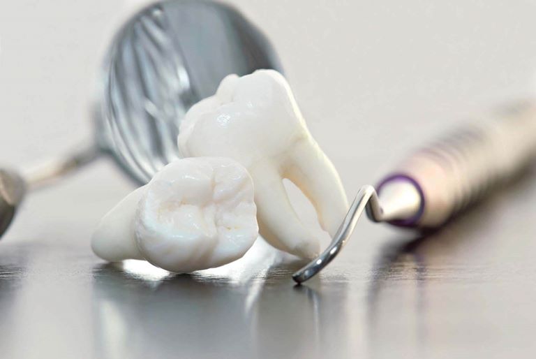 Лечение выпадения зубов у взрослых
