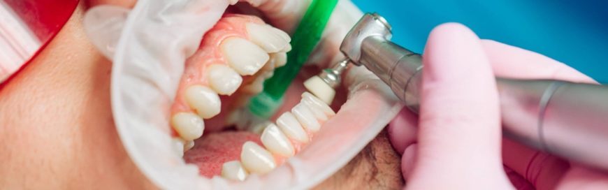 Как удалить зубной камень: плюсы и минусы популярных методов
