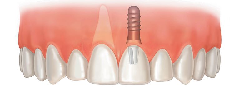 Специфика имплантации передних верхних зубов