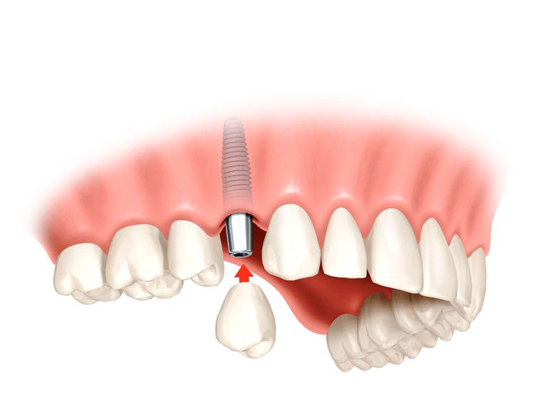 Имплантация жевательных зубов на верхней челюсти