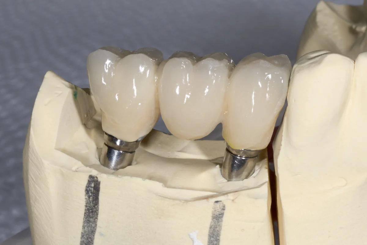 Анестезия и удаление корня зуба
