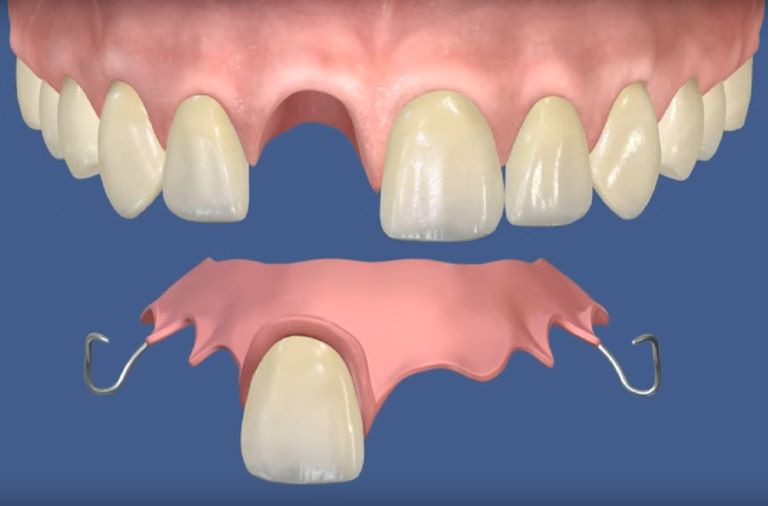 Импланты для зубов верхней челюсти