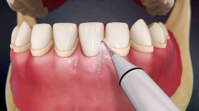 Причины появления зубного камня и симптомы