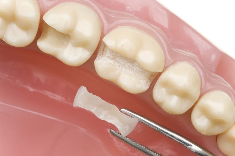 Показания для микропротезов – вкладок на зубы