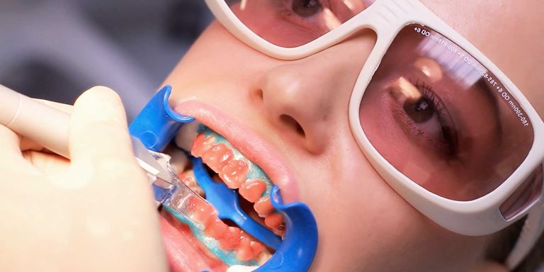 5 способов удалить зубной камень