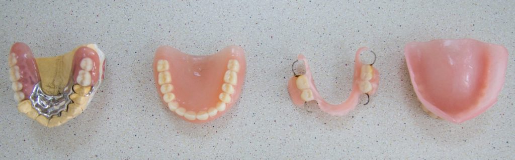 Чем заменить зубы: лучшие варианты протезирования и имплантации