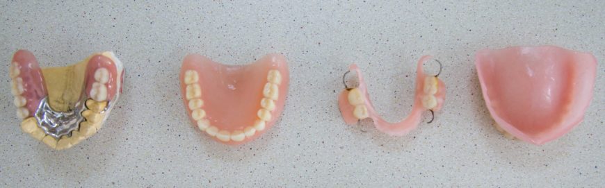 Чем заменить зубы: лучшие варианты протезирования и имплантации