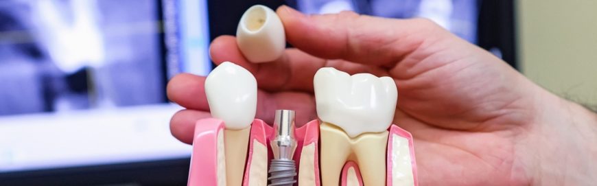 Что такое имплантация зубов: виды, показания, преимущества, процедура