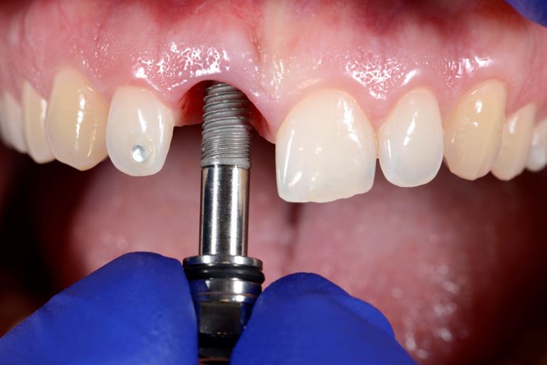 Показания к имплантации зубов