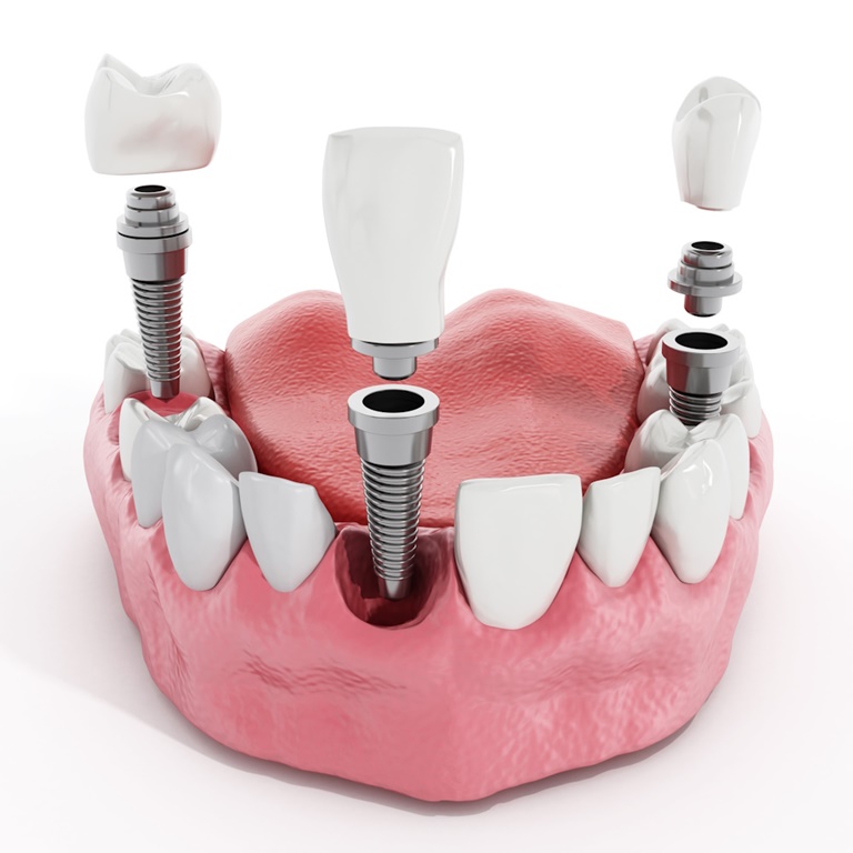 cуть имплантации зубов